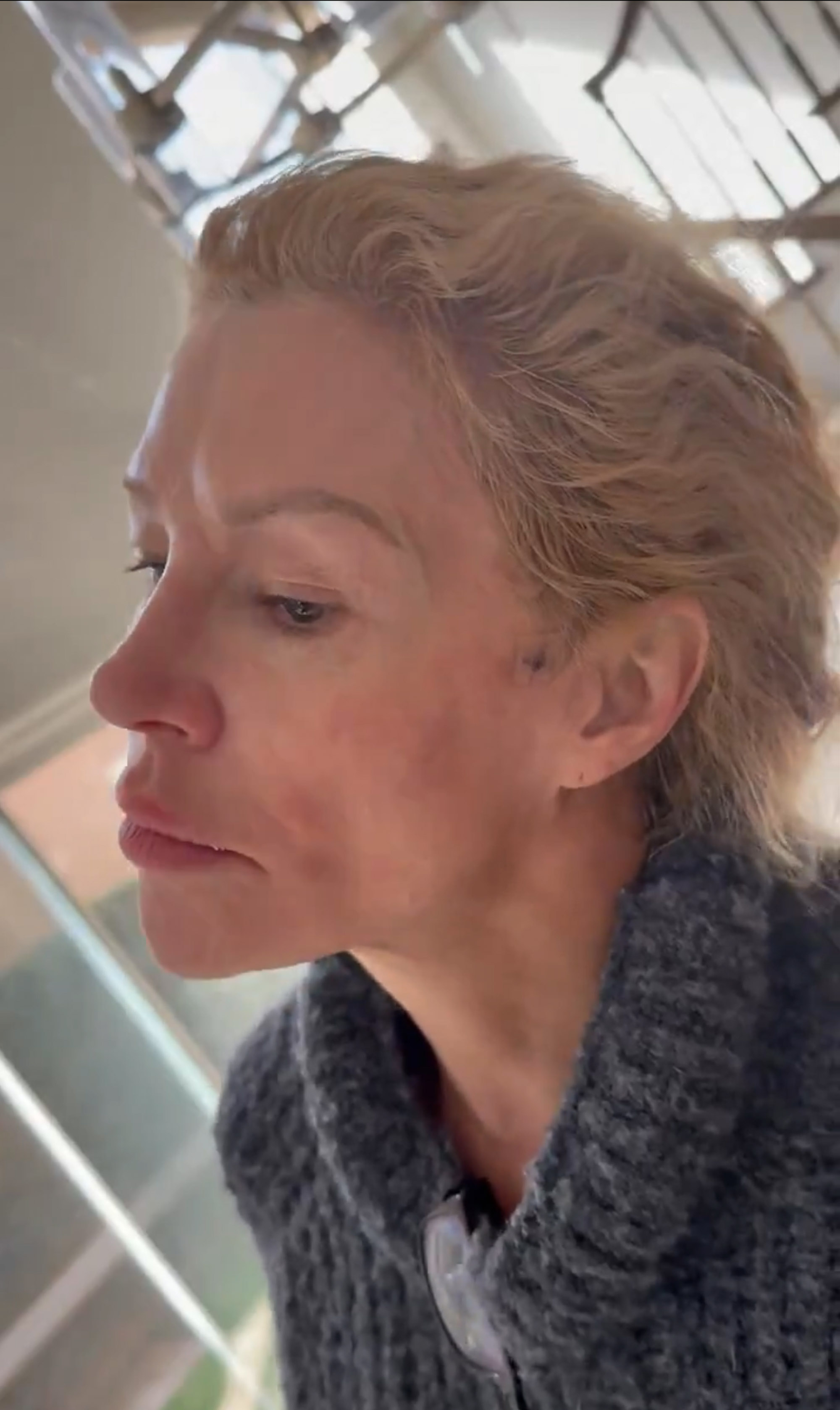 Brandi Glanville's face showing signs of treatment for a facial parasite.