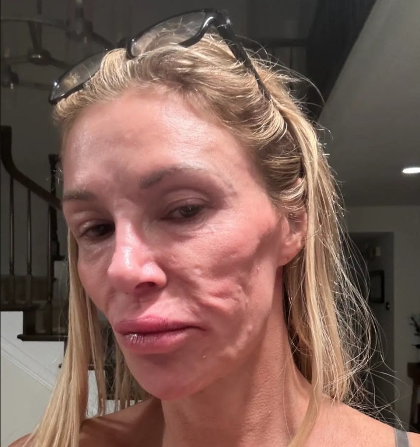 Woman with facial paralysis.